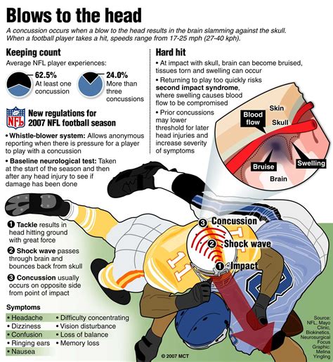 Football Concussion Graphic The Lance
