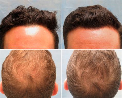 Hair Loss Injections Treatment