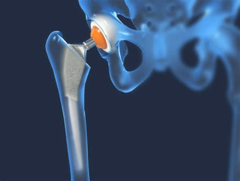 What Is A Hip Replacement Globmed