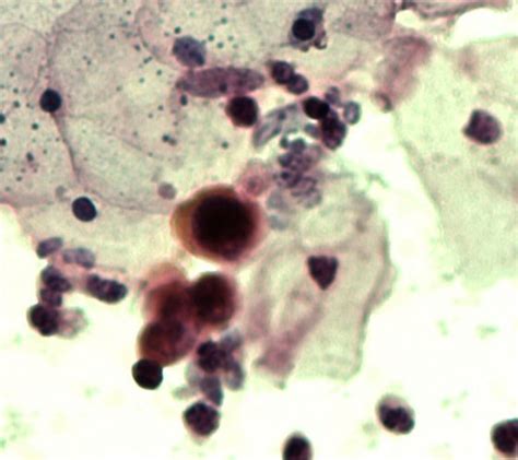 A P16l1 Hsil Case Small Group Of Basal Cells With An Enlarged
