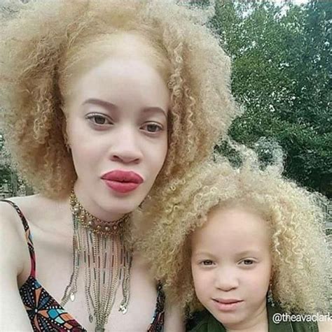 Albinism Is A Congenital Disorder That Removes Pigment From The Skin