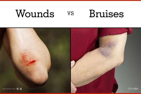 Wounds Vs Bruises By Dr Ajay Kumar Pujala Lybrate