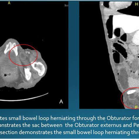 Ct Scan Demonstrates Small Bowel Loop Herniating Through The Obturator