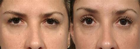 Non Surgical Eyebrow Lift Botox Brow Lift Thread Brow Lift Cost