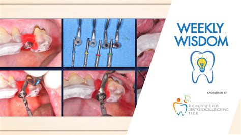Weekly Wisdom Computer Guided Implant Surgery Oral Health Group