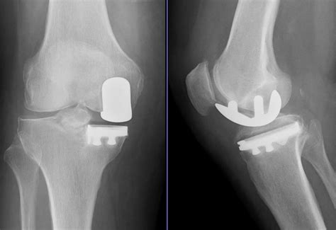 Just as halbs they are a counter unit and is only really good at killing cavalry or unprotected siege. You Have Options For Knee Pain | Go to Ortho