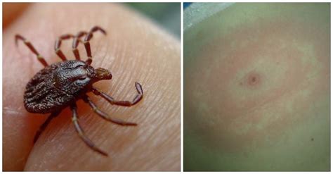 Tick Bites How To Avoid These Irksome And Dangerous Little Parasites