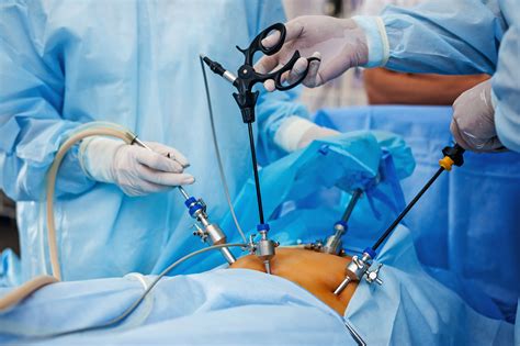 Cirurgia Bariátrica por Videolaparoscopia Cirurgia Bariatrica em Teresina Dr Aderson Aragão