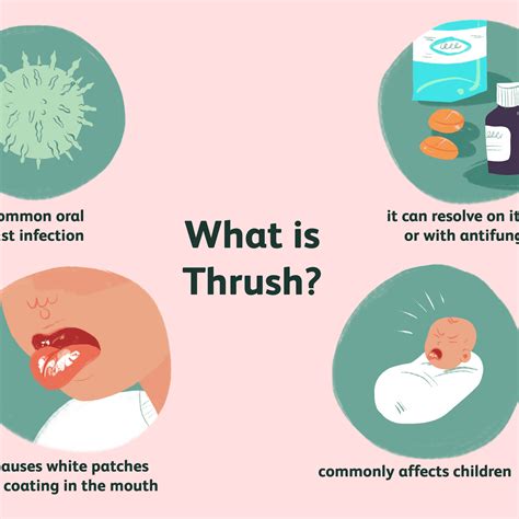 Oral Thrush Symptoms Causes And Treatments Explained Nature S Best