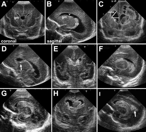 Germinal Matrix Neonatal Posthemorrhagic Hydrocephalus From