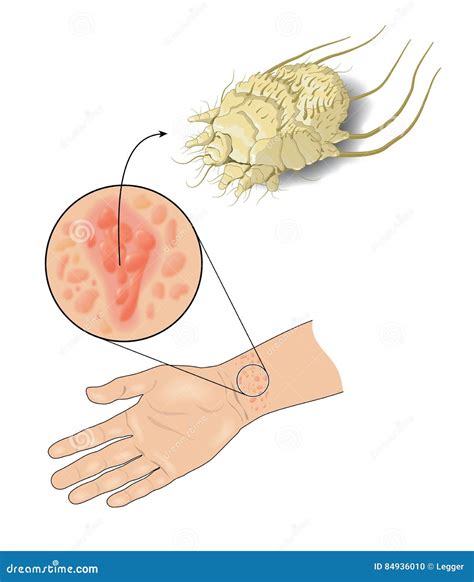 Scabies Stock Illustration Illustration Of Scabiei Itch 84936010