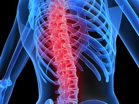 10 Penyebab Penyakit Osteoporosis
