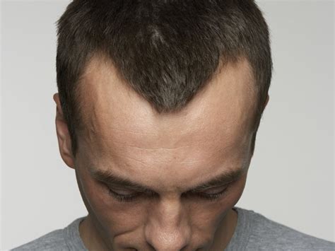 Receding Hairline Reasons Signs Treatment And Every Thing Human