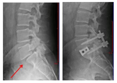 What Doctors Wish Their Patients Knew About Spinal Fusions