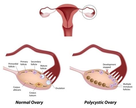 Polycystic Ovary Syndrome Medlineplus Genetics