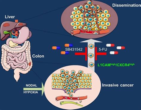 Nodal Induced L1camcxcr4 Subpopulation Sustains Tumor Growth And