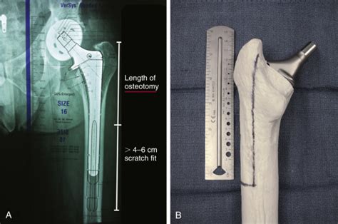 Extended Trochanteric Osteotomy For Femoral Revision Musculoskeletal Key