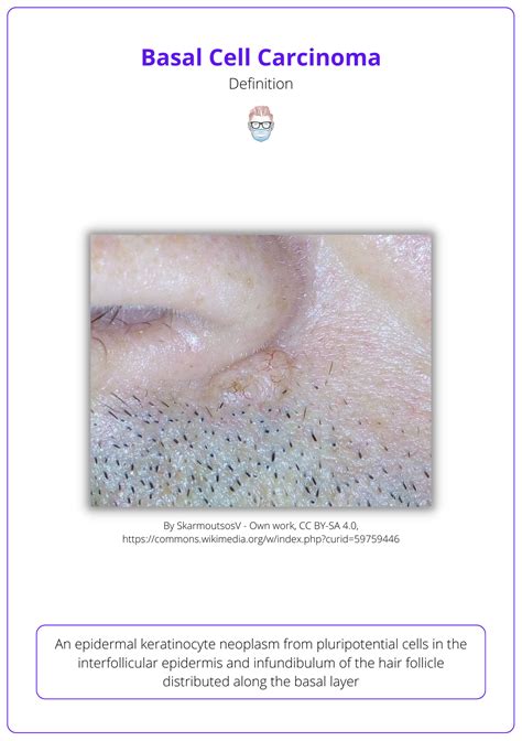 Basal Cell Carcinoma Bcc · Aetiology Diagnose Treat Follow Up