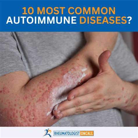 10 Most Common Autoimmune Diseases Rheumatologist Guide