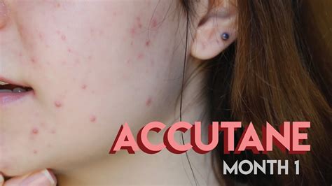 My First Month On Accutane Youtube
