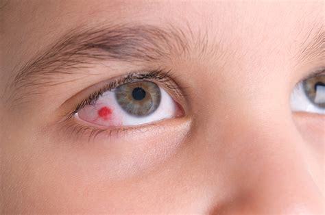 Burst Blood Vessel Optometrist In Houston Eye Site