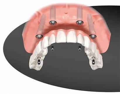 Fixed Implant Supported Denture Prosthesis