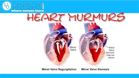 Diastolic Heart Murmurs Are Always Pathologic Hear Choices