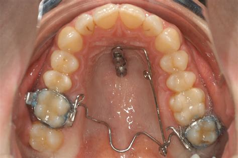 Maxillary Molar Intrusion Using Mini Implants In The Anterior Palate Mousetrap Versus Mini