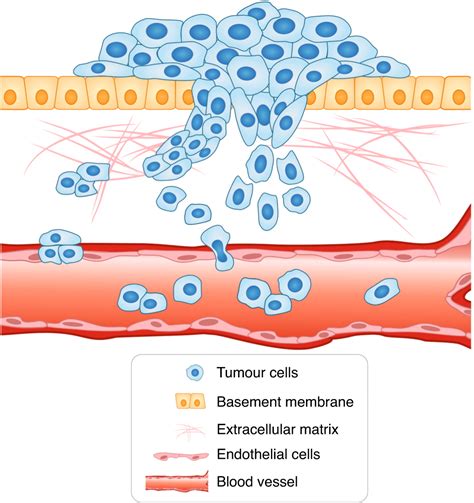 Pathology Outlines Curing Cancer Network Premalignant Disease