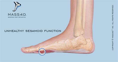In the foot and ankle many accessory ossicles can be seen. Diagnosis and Treatment of Sesamoiditis - MASS4D® Insoles ...