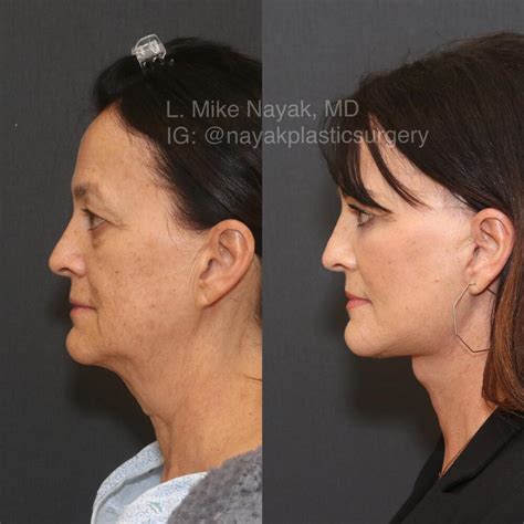 before and after deep necklift procedures in st louis mo nayak