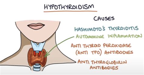 1 Hypothyroidism Flashcards Quizlet