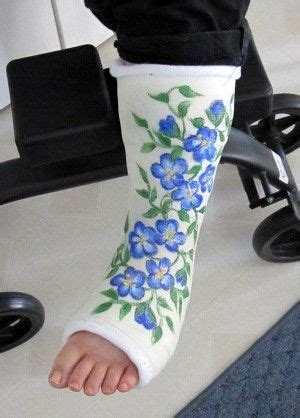 Here are some great ideas on how to decorate, bedazzle, and bling your cast, walking boot, and crutches. painted casts--garden style | Arm cast, Leg cast, It cast
