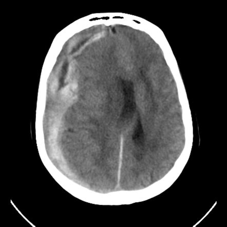 Acute Subdural Hemorrhage Radiology Case Radiopaedia Org
