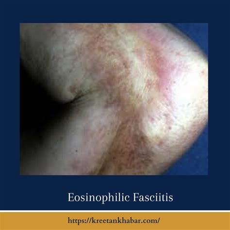 Eosinophilic Fasciitis Understanding A Rare Connective Tissue Disorder