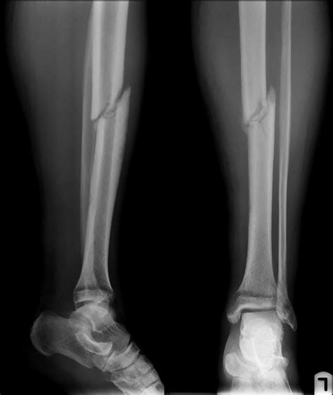 X Ray Leg Fracture