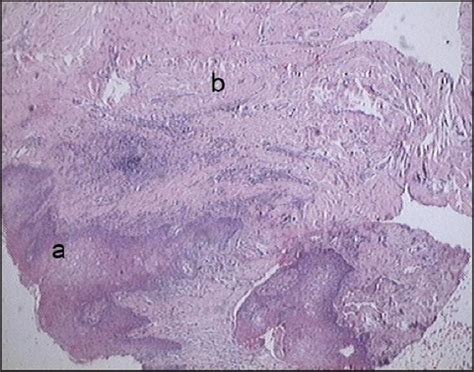 Histological Diagnosis Of Fibrous Inflammatory Hyperplasia Showed In