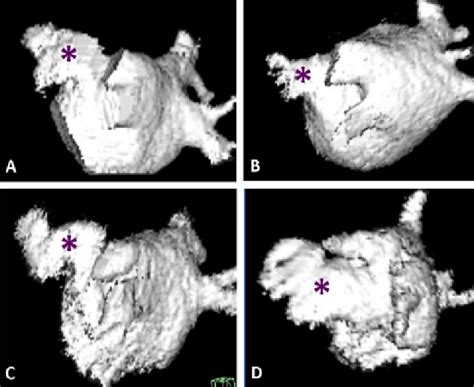 Representative Left Atrial Appendage Morphologies Three Dimensional