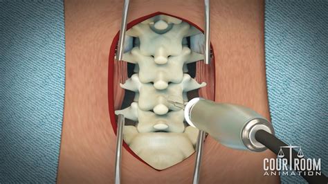 Microdiscectomy Scar