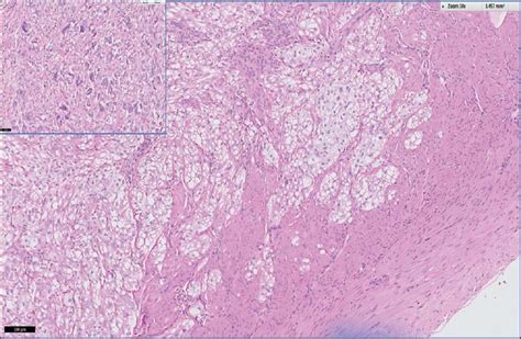 Uterine Perivascular Epithelioid Cell Tumour And Assessment Of Its