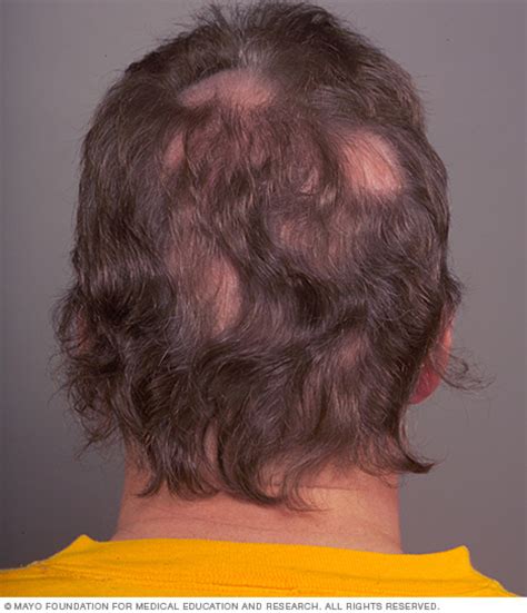 While some cats aren't affected by ringworm, in others it causes hair loss, resulting in visible circular patches, particularly on the body, head and ears. Hair loss Disease Reference Guide - Drugs.com
