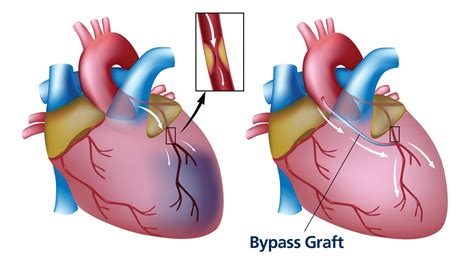 Cabg Coronary Artery Bypass Surgery Valley Health System