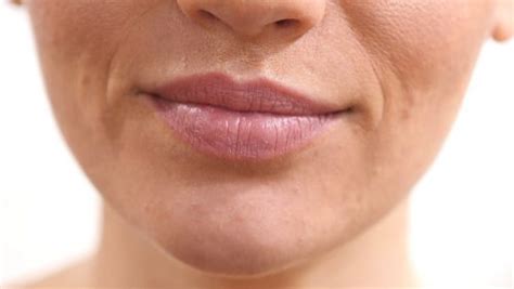 Wrinkles Around The Mouth Follow These Dermatologist Tips Home Bio