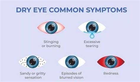 These Are The Symptoms Of Dry Eye Syndrome Medizzy