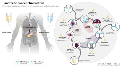 Pancreatic Cancer Clinical Trial With Immunotherapy And Chemotherapy
