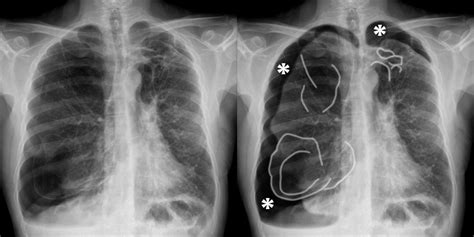 Chest X Ray Pneumothorax Gallery Copd Bilateral Pneumothoraces