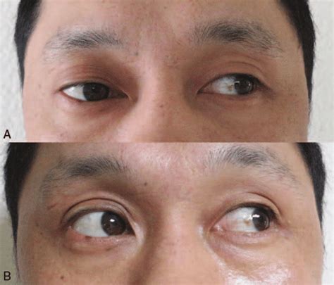 Diplopia is a vision alteration consisting in the perception of double vision. (A) The patient had diplopia when looking left. (B) His ...