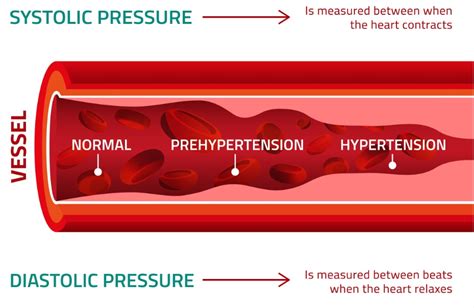 High Blood Pressure Causes Facts And Numbers Prevention And Natural