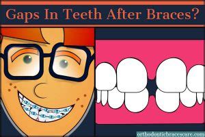 The gap usually forms gradually over a period of time. Gaps In Teeth After Braces: Is It Normal, How To Fix It ...