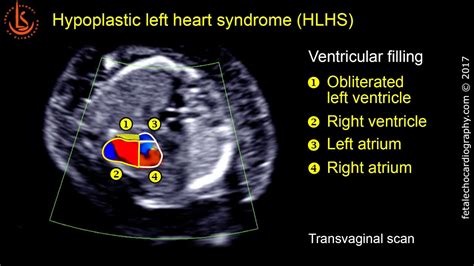 Fetal Echocardiography At 11 13 Weeks Hypoplastic Left Heart Syndrome